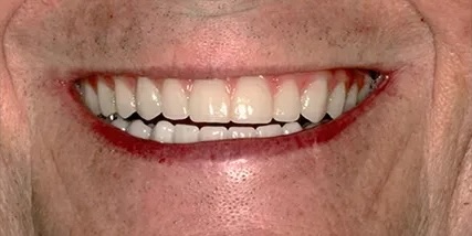 Case 1 After